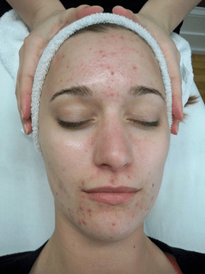 Forskellen på almindelige bumser og cystisk akne Bumser i T-zonen - Hudlæge Alba Privathospital