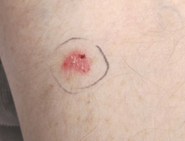 Hudkræft på arm - Hudlæge Alba Privathospital