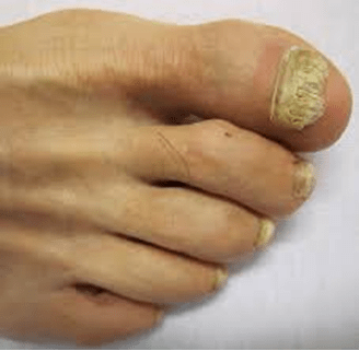 Ringorm & neglesvamp Før efter fjernelse af keloid på øre - Alba Privathospital