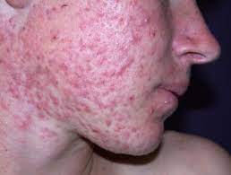 Forskellen på almindelige bumser og cystisk akne Svær akne - Hudlæge Alba Privathospital