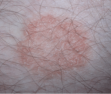 Ringorm & neglesvamp Svampeinfektion i huden - Hudlæge Alba Privathospital