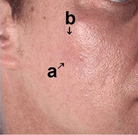 Efter subcision af aknear – Hudlæge Alba Privathospital
