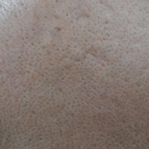 Efter udstansning af aknear – Hudlæge Alba Privathospital