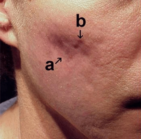 Før subcision af aknear – Hudlæge Alba Privathospital Før subcision af aknear – Hudlæge Alba Privathospital