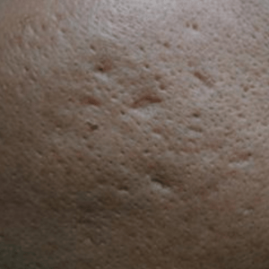 Før udstansning af aknear – Hudlæge Alba Privathospital Før udstansning af aknear – Hudlæge Alba Privathospital