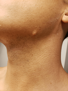 Hvad er keloid ar & hypertrofiske ar Hypertrofisk aknear - Hudlæge Alba Privathospital