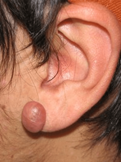 Hvad er keloid ar & hypertrofiske ar Behandling af keloid på øre - Før og efter - Alba Privathospital