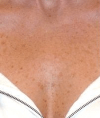 Før laserbehandling af bryst - Alba Privatklinik