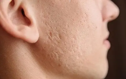 Hvordan undgår jeg at få ar efter akne? Akne og ardannelse på kinden vist som patient hos Alba Privathospital ved evaluering af acne scars og hudforbedring, uden reklame.