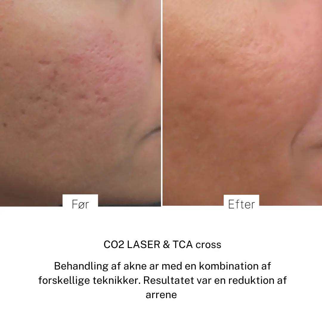 Pigmenter, ar, strækmærker & karsprængninger Eksem på hænderne - Hudlæge Alba Privathospital