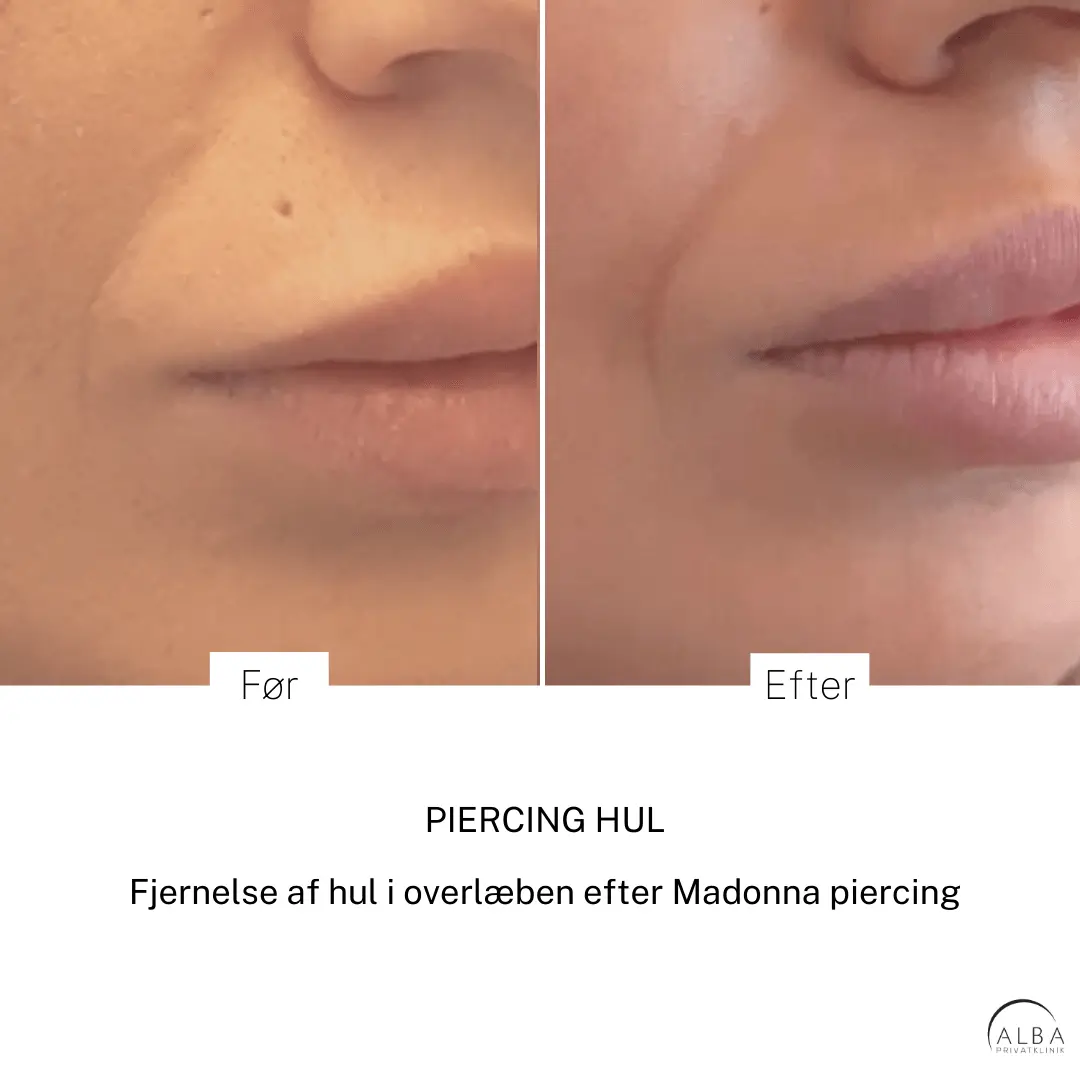 Behandling af bumser - hudlæge - Alba Privathospital