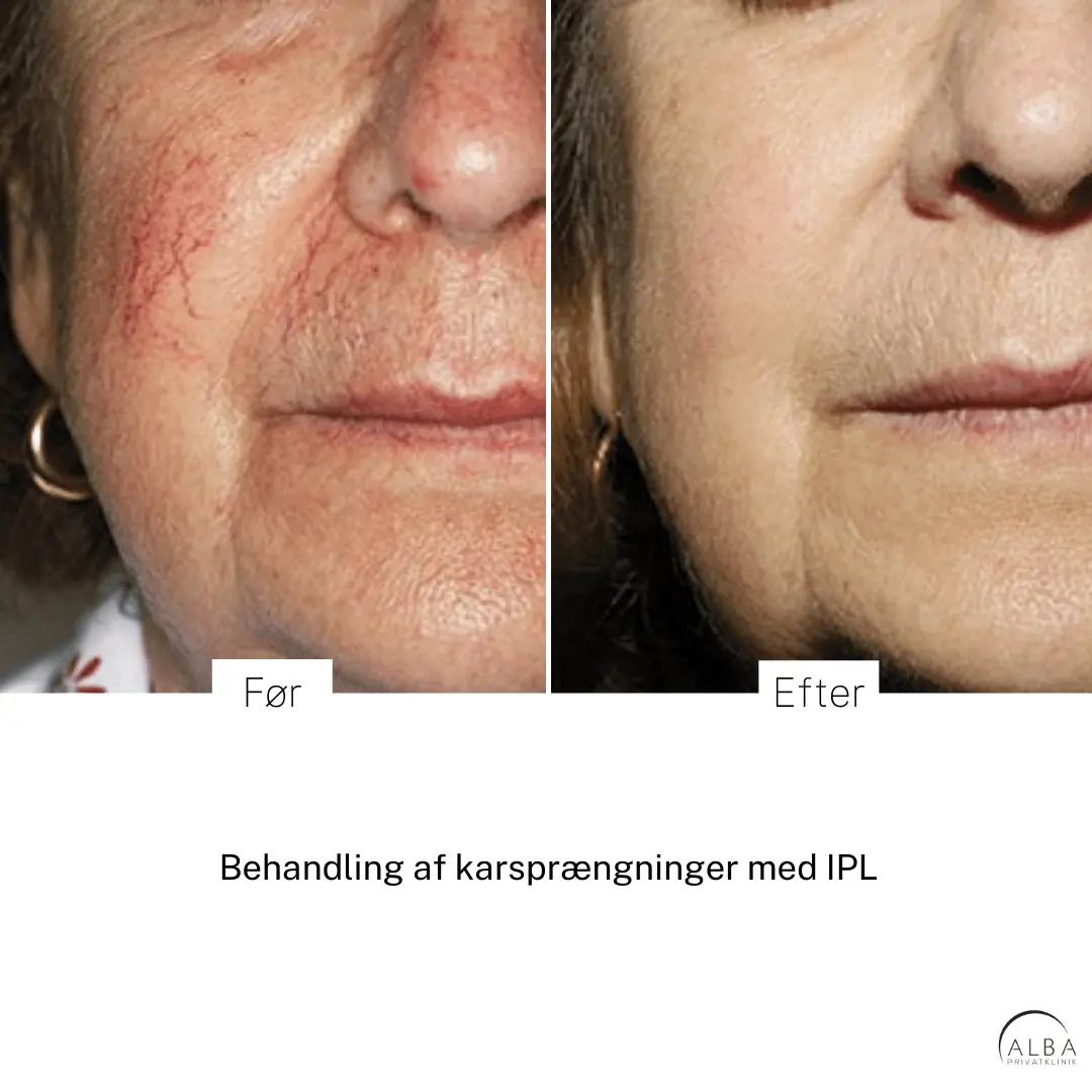IPL behandling af karsprængninger