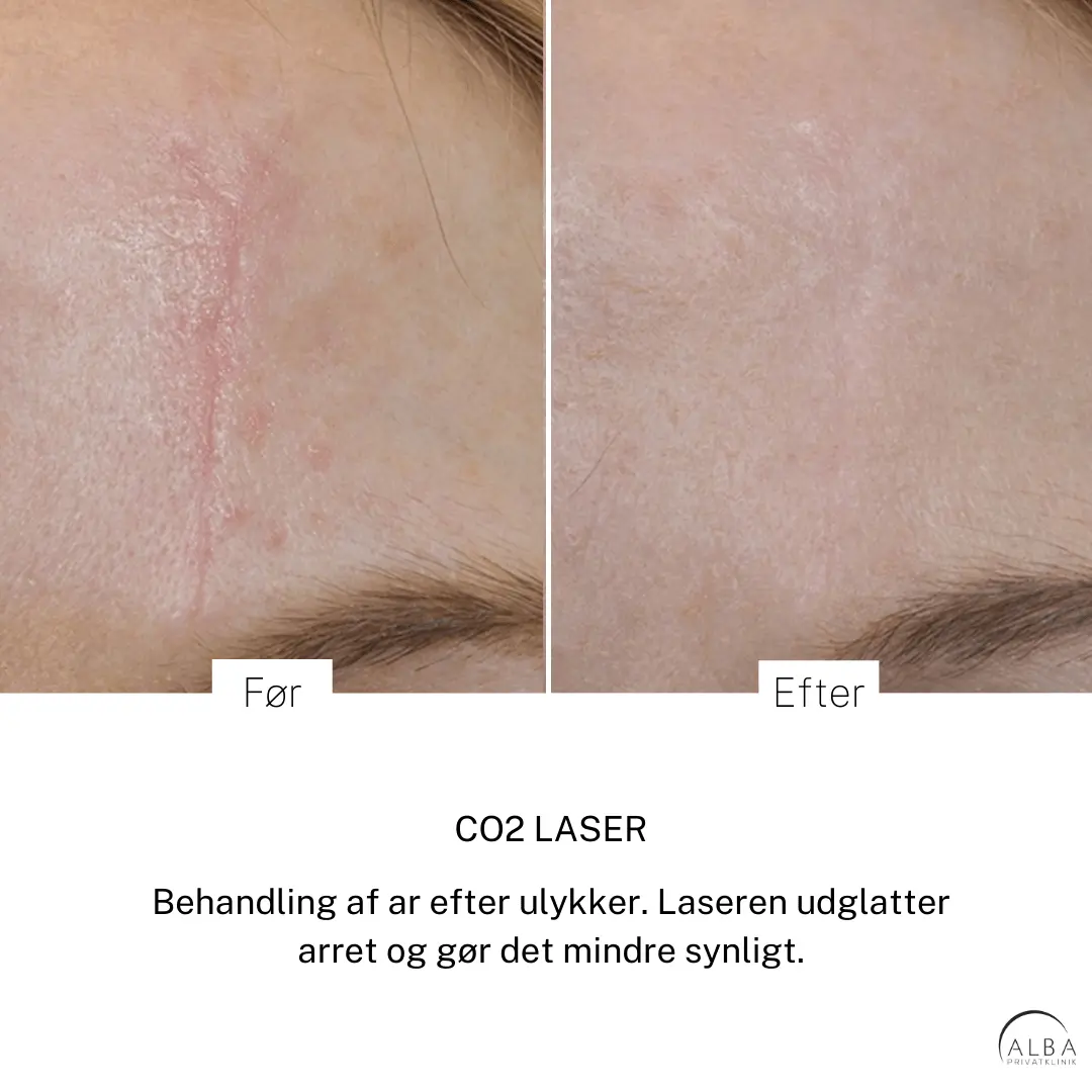 Pigmenter, ar, strækmærker & karsprængninger Eksem på hænderne - Hudlæge Alba Privathospital