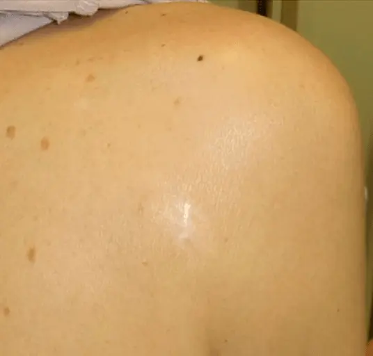 Keloid efter behandling – Hudlæge Alba Privathospital