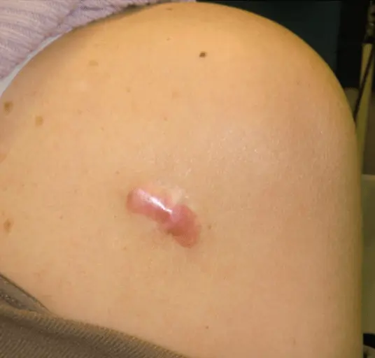 Keloid før behandling – Hudlæge Alba Privathospital