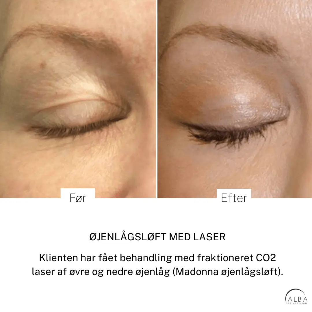 Eksem på hænderne - Hudlæge Alba Privathospital