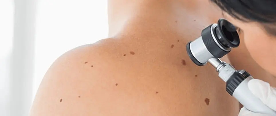Hvornår bør du få tjekket en plet hos hudlægen? Alba Privatklinik: hudundersøgelse med dermatoskop viser modermærker på skulder og øvre ryg hos patient; klinikmiljø og medicinsk udstyr i fokus.