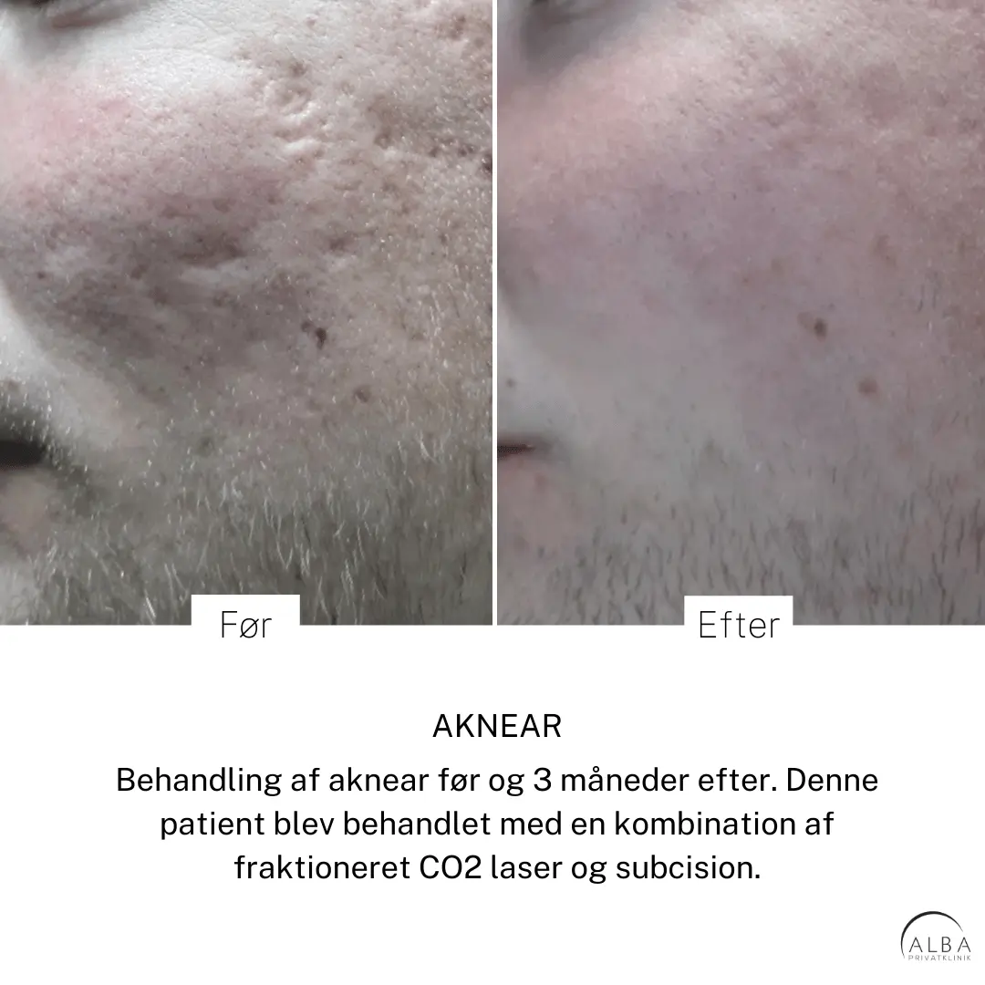 Pigmenter, ar, strækmærker & karsprængninger Eksem på hænderne - Hudlæge Alba Privathospital