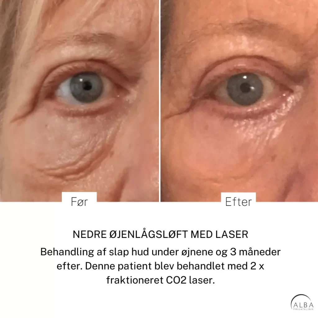 Før og efter billede af nedre øjenlågsløft med laser hos Dr. Ulrik Knap på Alba Privathospital. Fokus på reduktion af rynker og løs hud under øjnene.