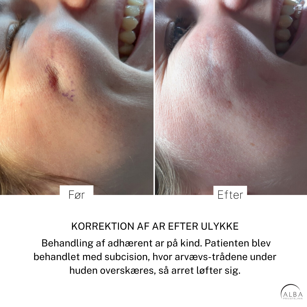 Pigmenter, ar, strækmærker & karsprængninger Behandling af ar med subcision - Alba Privathospital