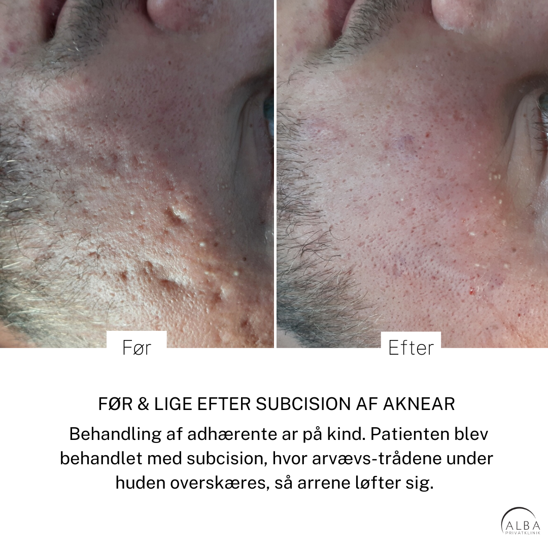 Subcision af aknear Behandling af bumser - hudlæge - Alba Privathospital
