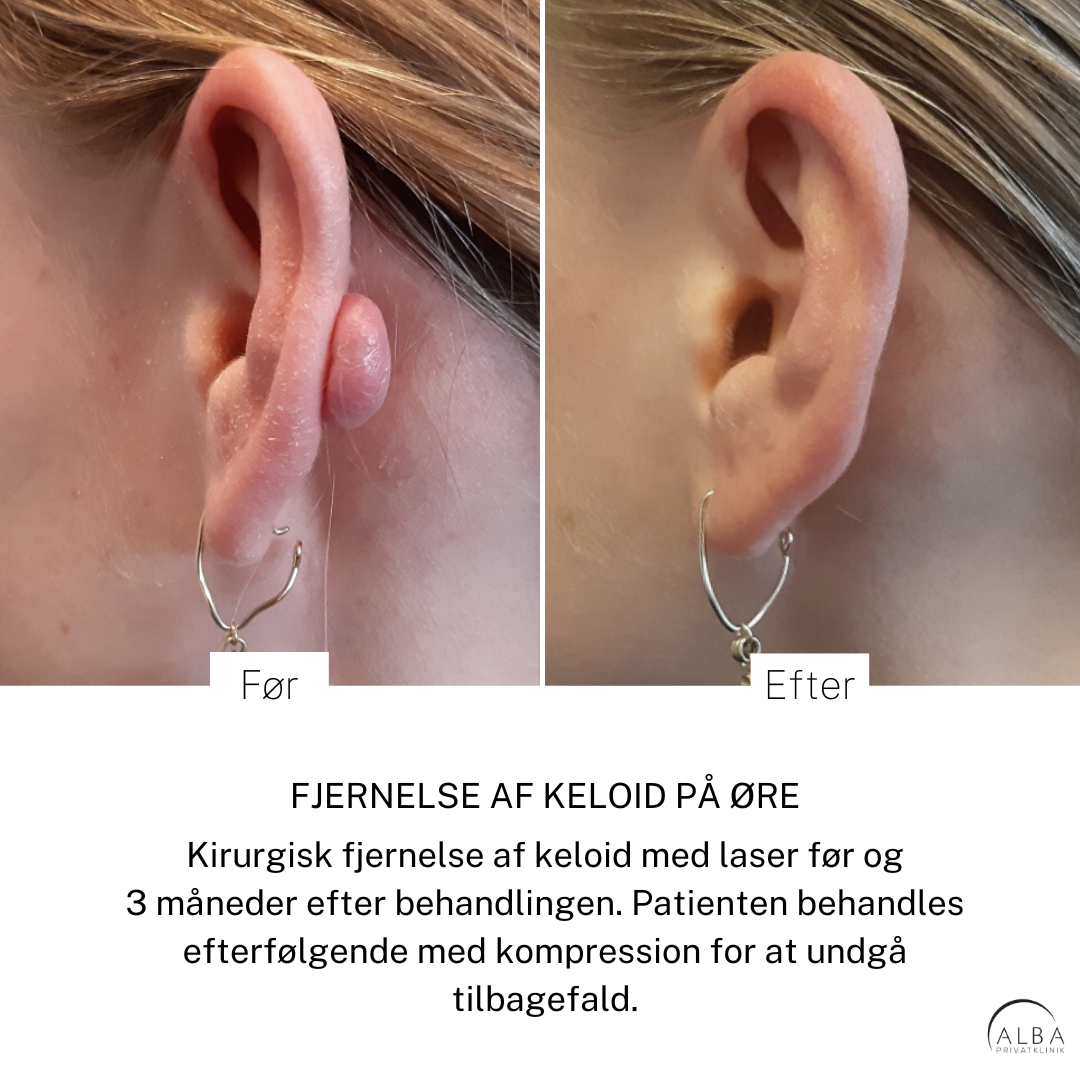 Behandling af fortykkede ar & keloid ar Behandling af keloid på øre - Før og efter - Alba Privathospital