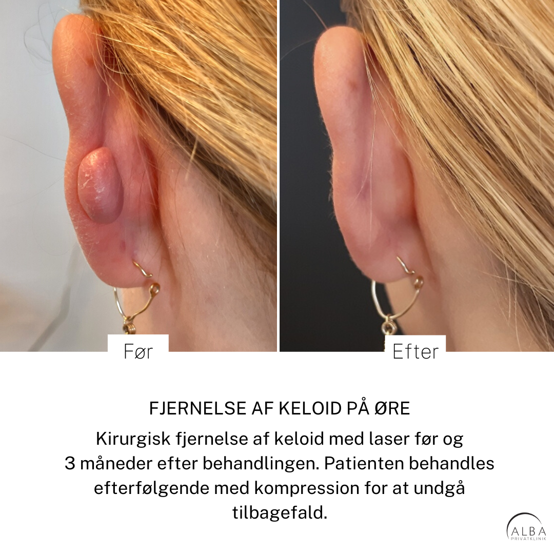 Behandling af fortykkede ar & keloid ar Behandling af keloid på øre - Før og efter - Alba Privathospital