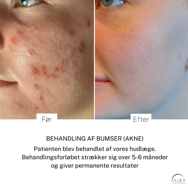 Aknefri behandling (effektiv behandling af bumser & uren hud) Aknebehandling - Hudlæge | ALBA Privathospital