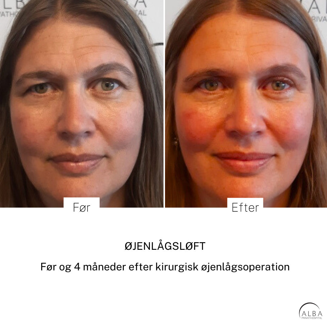 Før og efter øjenlågsoperation | ALBA Privathospital