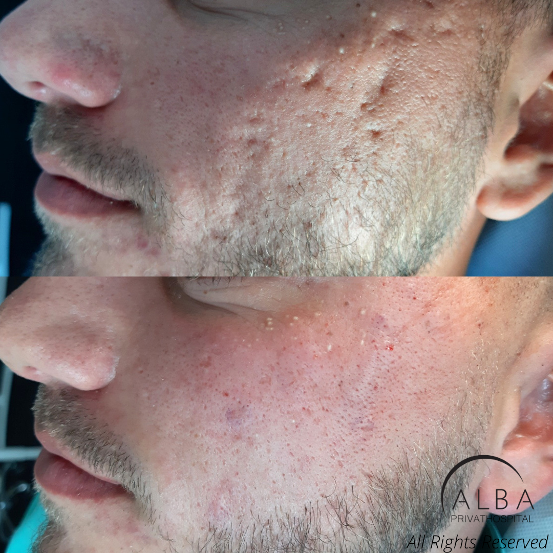 Ar efter bumser (aknear) Behandling af bumser - hudlæge - Alba Privathospital