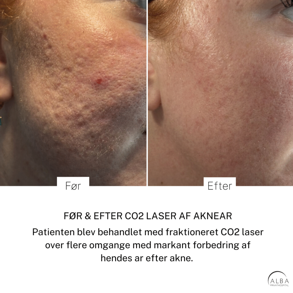 Før- og efter-billede af aknebehandling med CO2-laser på ansigtet, der viser betydelig hudforbedring og reduceret ujævnhed hos Alba Privathospital.