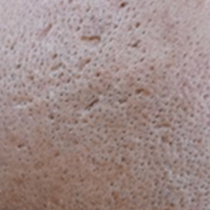 Behandling af ar efter bumser (Akne) Issyl aknear - Hudlæge Alba Privathospital