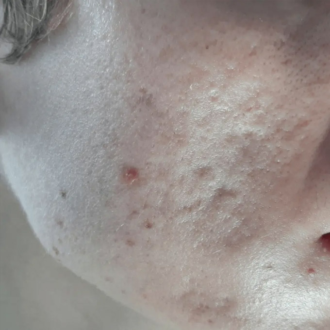 Behandling af ar efter bumser (Akne) Fortykkede aknear - Hudlæge Alba Privathospital