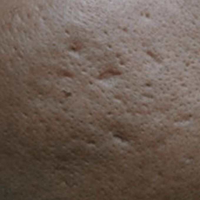 Behandling af ar efter bumser (Akne) Før udstansning af aknear - Hudlæge Alba Privathospital