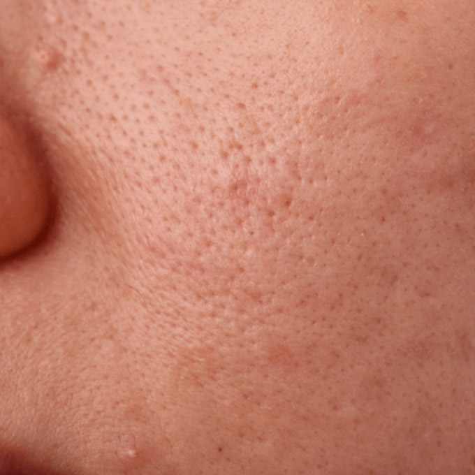 Behandling af ar efter bumser (Akne) Store porer behandling - Alba Privathospital