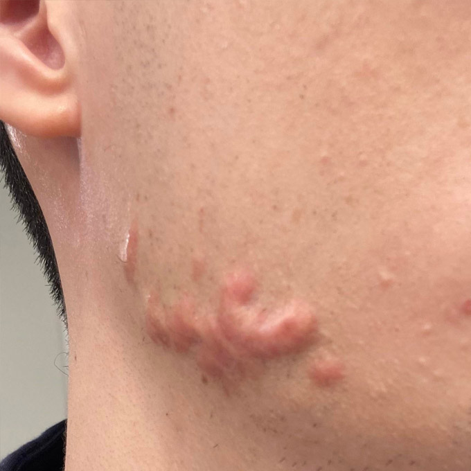 Behandling af ar efter bumser (Akne) Fortykkede aknear - Hudlæge Alba Privathospital