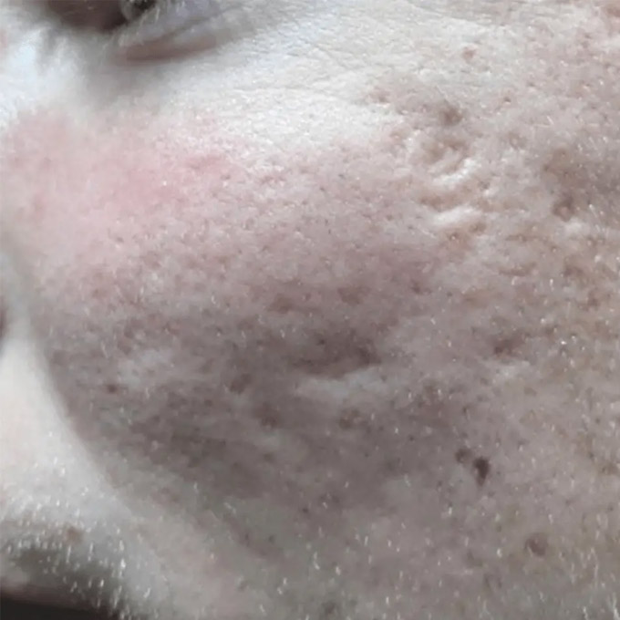 Behandling af ar efter bumser (Akne) Behandling af ar efter bumser (Akne)