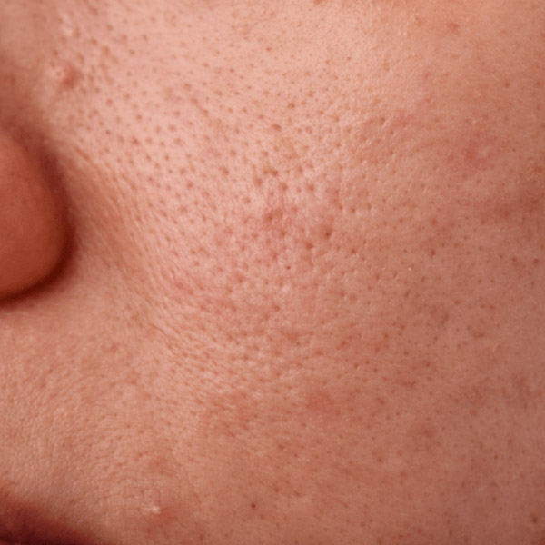 Forsænkede (atrofiske) aknear Store porer behandling - Alba Privathospital