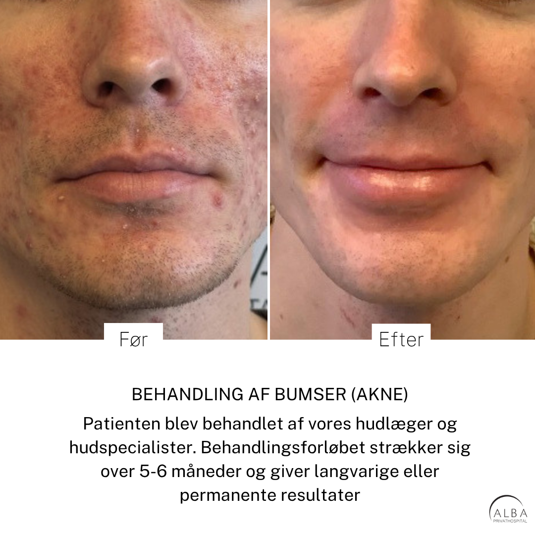 Behandling af bumser Før og efter - ALBA Privathospital.