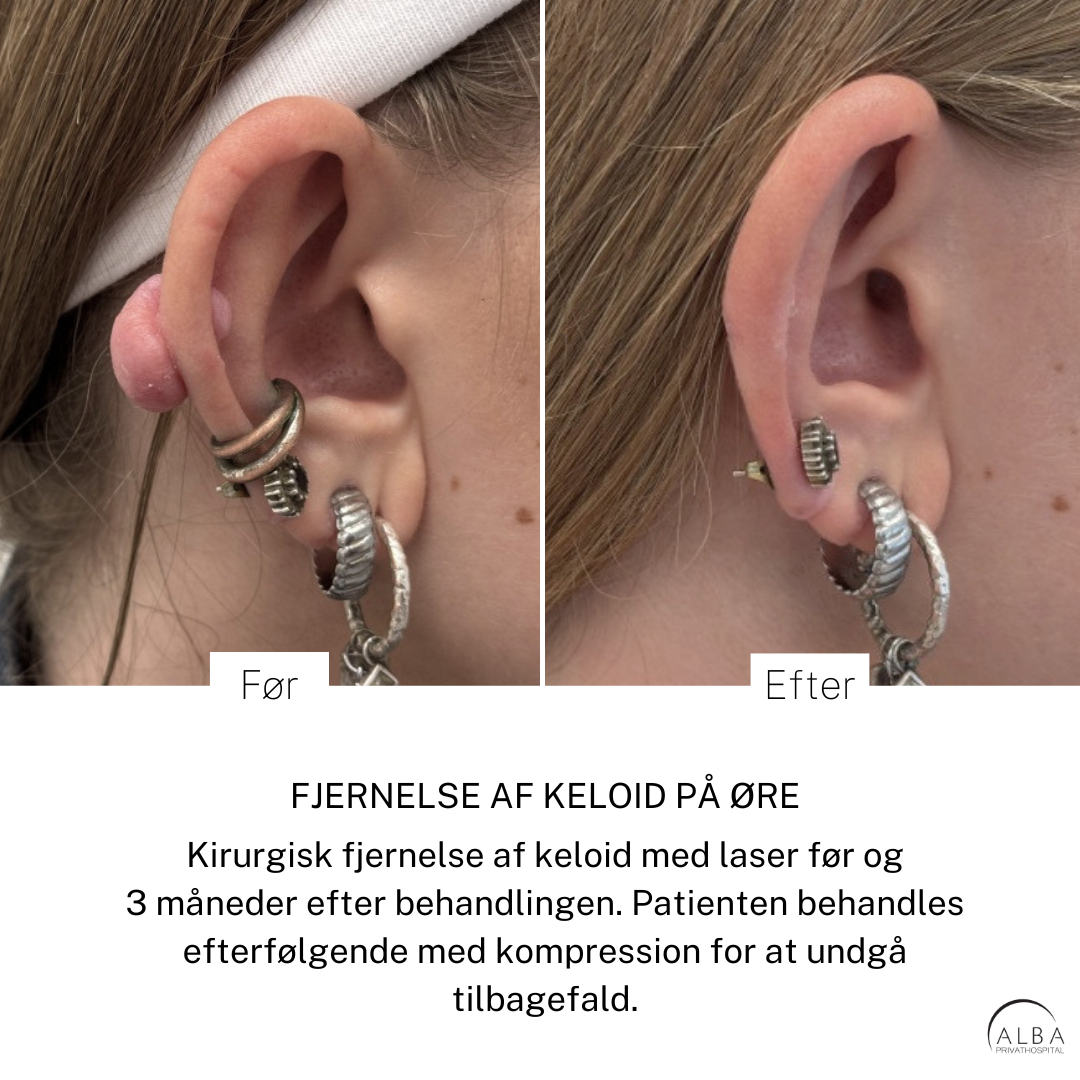 Behandling af keloid på øre - Hudlæge - ALBA Privathospital