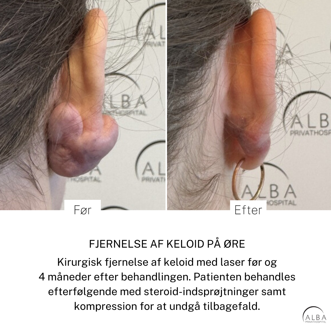 Behandling af stort ørekeloid _ ALBA Privathospital