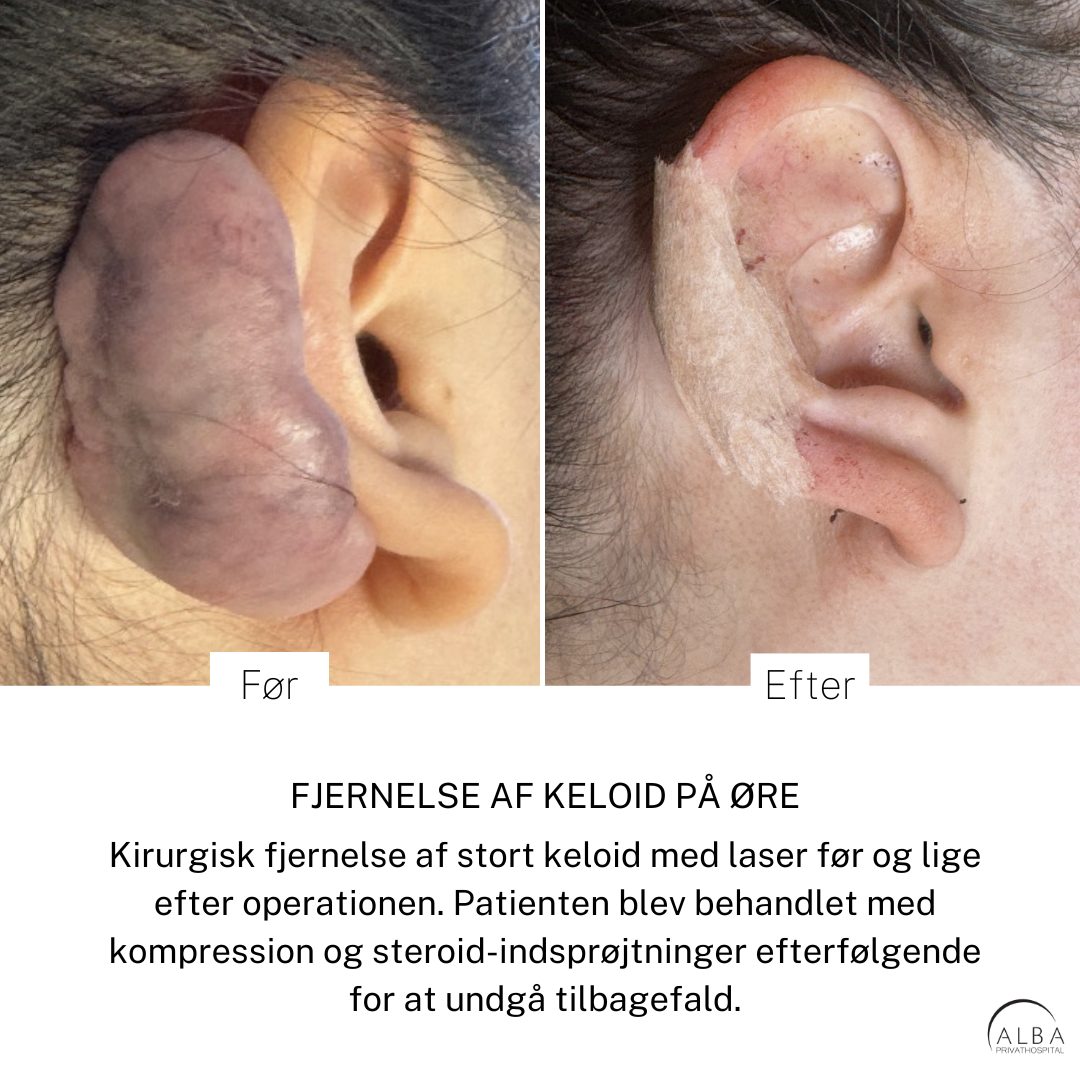 Før og lige efter operation af stort keloid på øre - ALBA Privathospital
