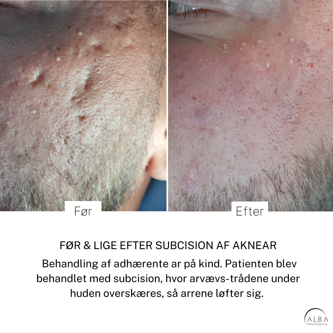 Laserbehandling af aknear Akne ar - Behandling med subcision før og efter - ALBA Privathospital