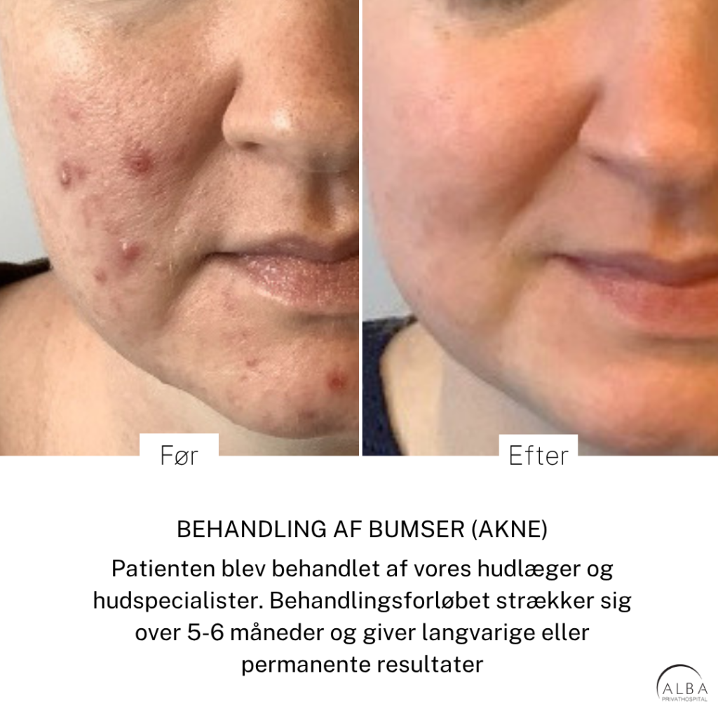 Hormonel akne hos voksne kvinder Før og efter-behandling af bumser (akne) ved ALBA Privathospital med teksten 'Før' og 'Efter' over rødlig og ujævn hud.