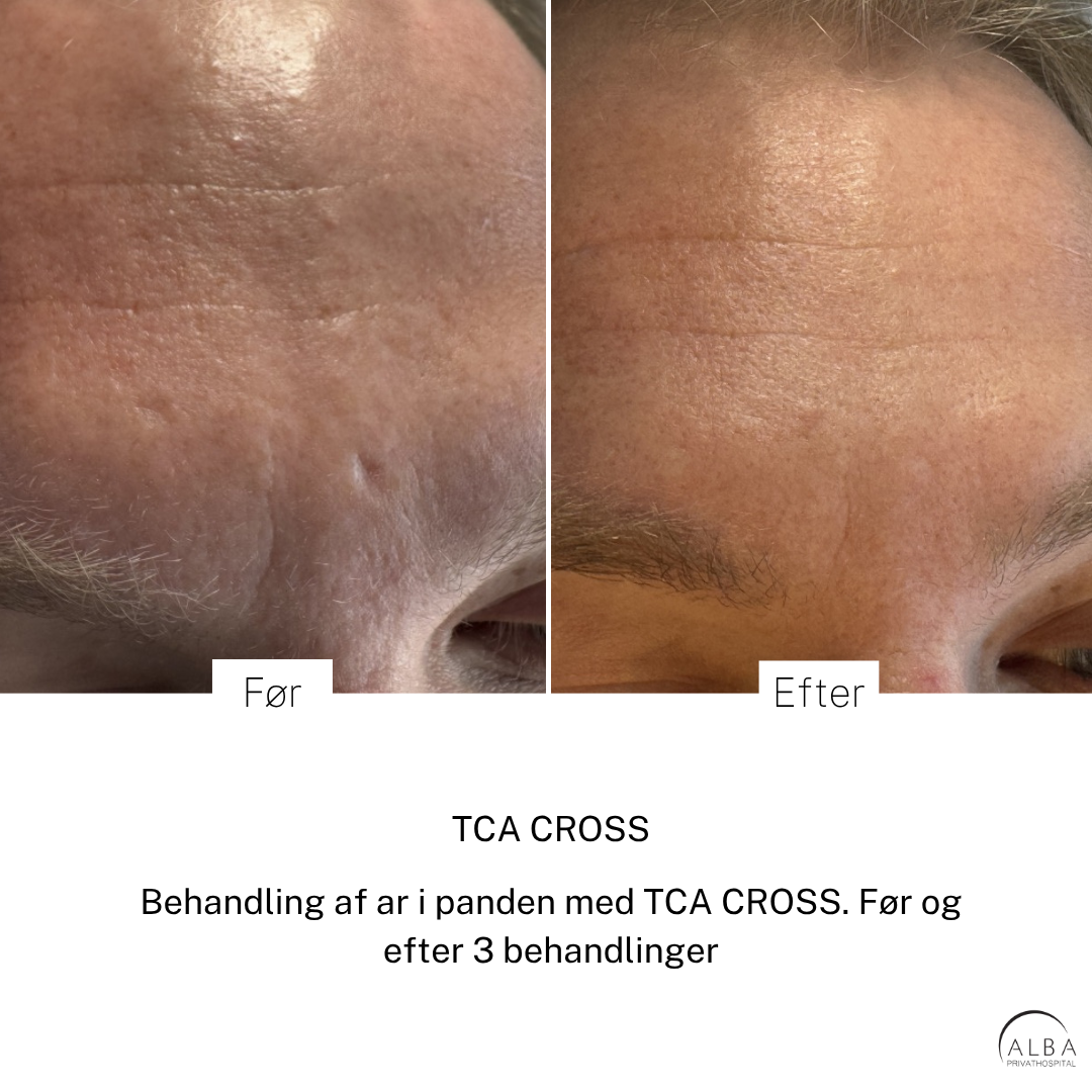Før og efter behandling af ar i panden med TCA CROSS, vist hos ALBA Privathospital; tydelige markeringer med “Før” og “Efter”.