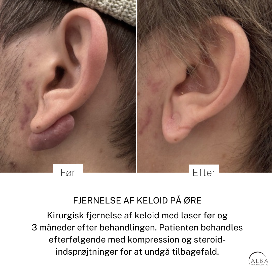 Keloid - før og efter behandling - side - ALBA Privathospital