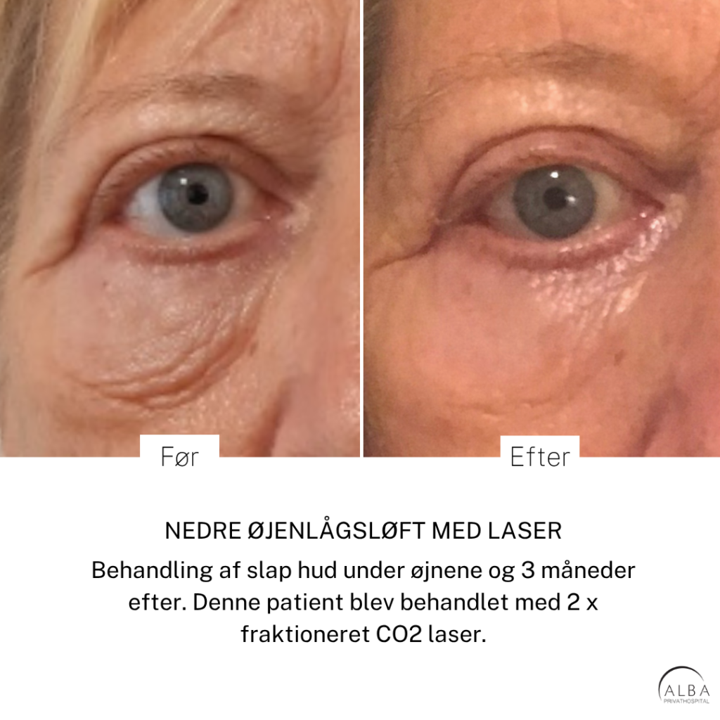 Fraktioneret CO2-laser: Disse ting skal du være opmærksom på Detaljer af nedre øjenlåg før og efter CO2-laserbehandling hos ALBA Privathospital, med fokus på slap hud under øjnene.