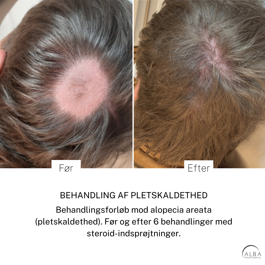 Pletskaldethed ved alopecia areata, før og efter behandling, med tydelig skaldet plet i hovedbunden og spredt lysebrunt hår omkring.