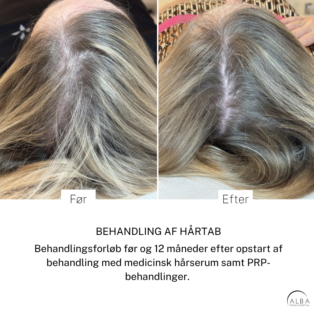 Behandling af hårtab hos kvinde - Før og efter - ALBA Privathospital