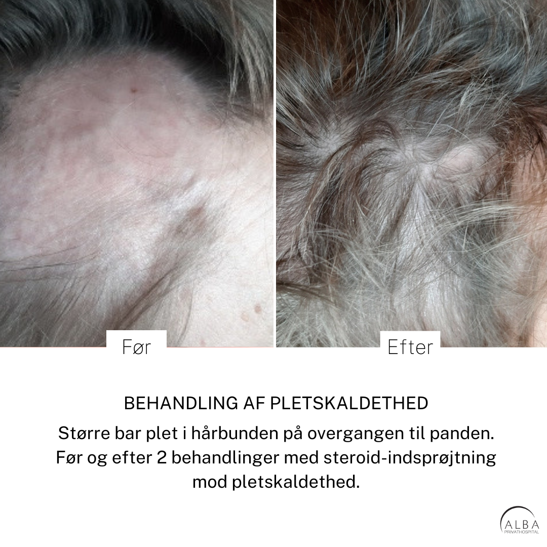 Pletskaldethed - før efter behandling - ALBA Privathospital
